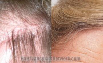 Before and after hair transplantation result photographs