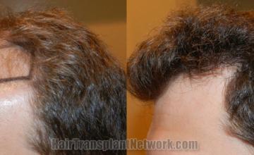Before and after hair transplantation result photographs