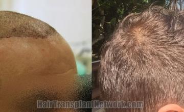 Before and after hair transplantation result photographs