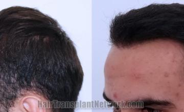 Before and after hair transplantation result photographs