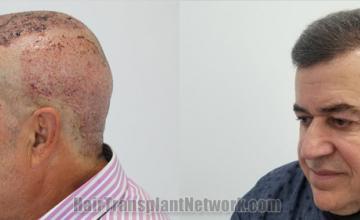 Hair restoration procedure results