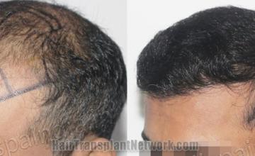 Before and after hair transplantation result photographs