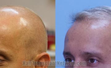 Before and after hair transplantation result photographs