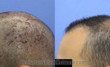 Hair restoration procedure before and after pictures