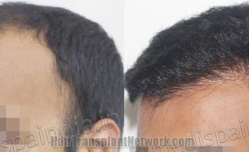 Before and after hair transplantation result photographs