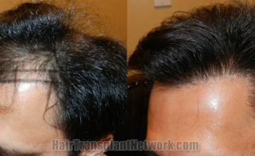 Before and after hair transplantation result photographs
