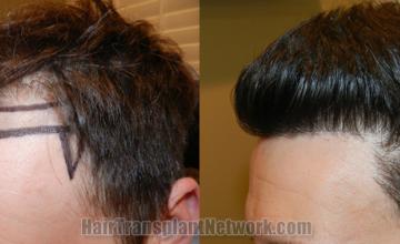  before and after result photographs
