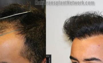 Before and after hair transplantation result photographs