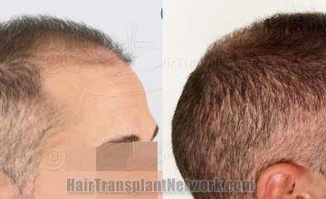  before and after result photographs