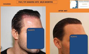 Hair transplantation surgery before and after pictures