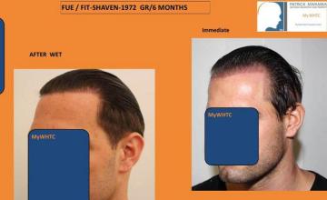 Hair restoration procedure before and after pictures