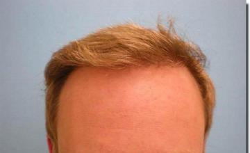 Hair restoration procedure results