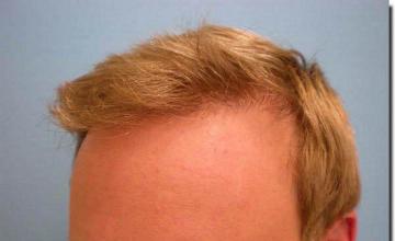 Hair restoration procedure results