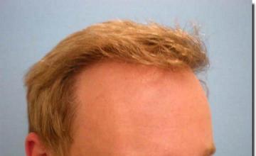 Hair restoration procedure results