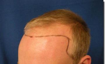 Hair restoration procedure results