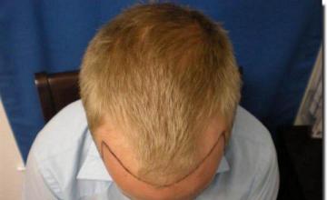 Hair restoration procedure results