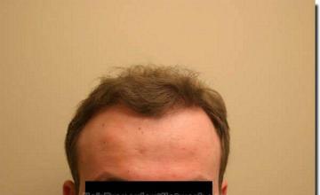 Hair restoration procedure results