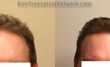 Front view - Before and after