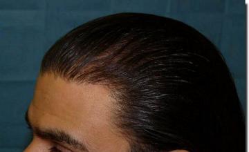 Hair restoration procedure results