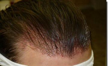 Hair restoration procedure results