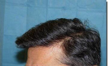 Hair restoration procedure results