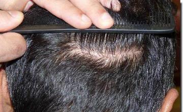 Hair restoration procedure results