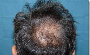 Hair restoration procedure results