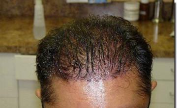 Hair restoration procedure results