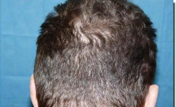 Hair restoration procedure results