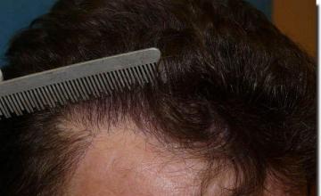 Hair restoration procedure results