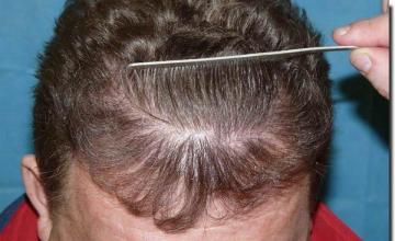 Hair restoration procedure results