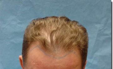 Hair restoration procedure results