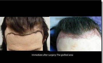 Hair restoration procedure results