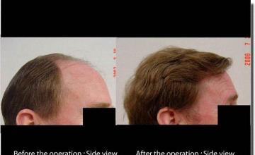 Hair restoration procedure results