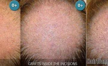 Hair restoration before and after photos