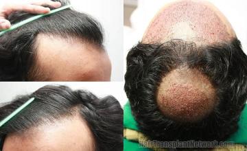 Hair restoration surgery before and after photos