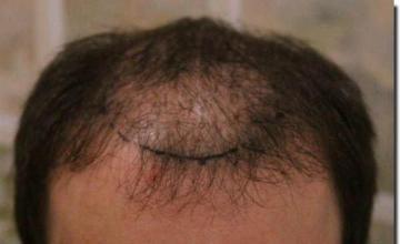 Hair restoration procedure results