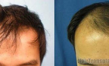 Hair transplant results 1742 grafts after 10 months