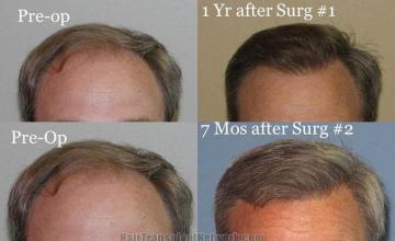 Before and after hair transplant procedure images