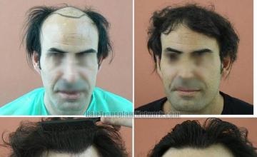 Hair transplantation surgery before and after photos