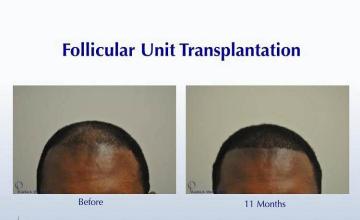 Hair restoration procedure before and after results