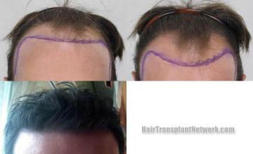 Hair transplantation surgery before and after images