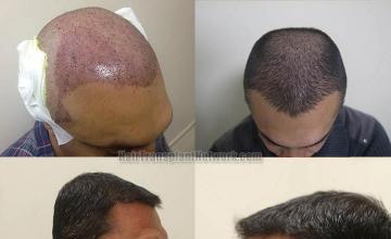 Hair restoration procedure before and after result photographs