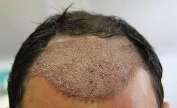 Hair restoration surgery before and after images