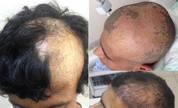 Hair transplantation surgery before and after images