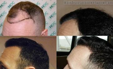 Hair restoration procedure before and after pictures