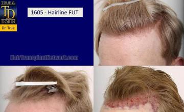 Hair transplantation surgery before and after images
