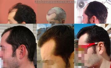 Hair restoration procedure before and after pictures