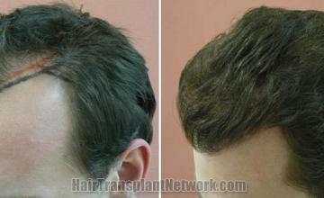 Hair restoration procedure before and after results