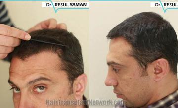 Hair transplantation surgery before and after pictures